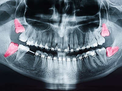 The image shows an X-ray of a human skull with red dots indicating areas of interest, possibly for medical analysis or teaching purposes.