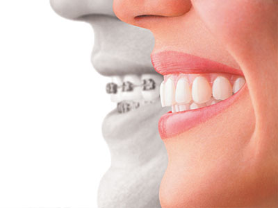 The image shows a split view of two different mouths with teeth, one on the left side appearing natural and the other on the right side showing dental implants.