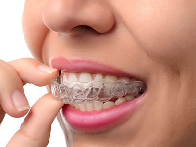 The image shows a person with braces holding their teeth, focusing on the braces.