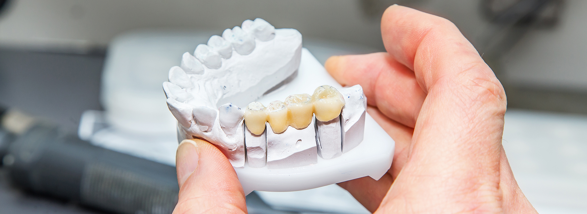 The image shows a person holding a tooth model with a close-up view of a dental implant fixture, showcasing the design and structure of the implant.