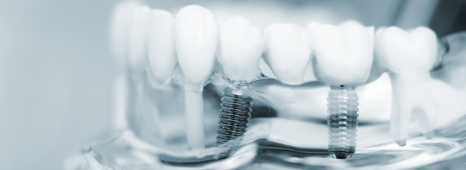 The image shows a close-up view of multiple dental implants with screws and possibly other components, all appearing to be part of a dental prosthesis or implant system.