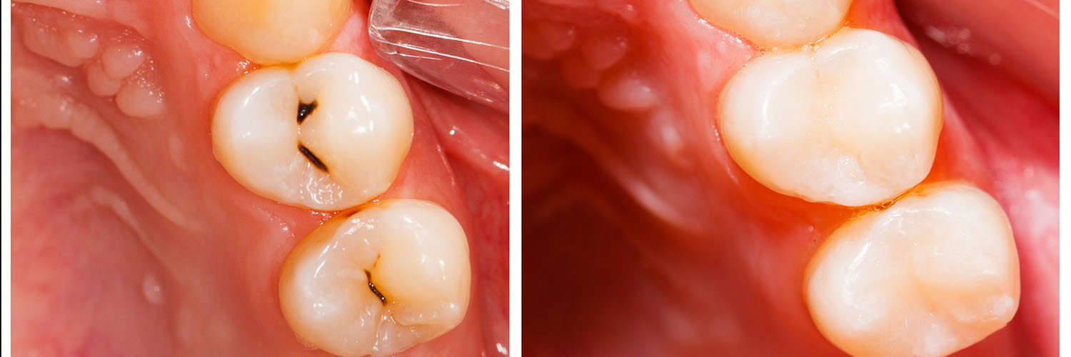 The image shows a close-up view of a human mouth with teeth, gums, and a tongue, featuring an overlay of a measuring tool indicating dental dimensions for reference.