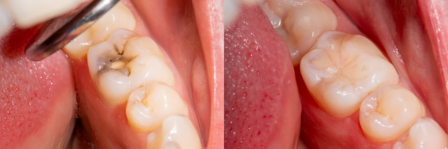The image displays a close-up view of a dental implant procedure in progress, with a focus on the surgical area where a tooth has been removed and an implant is being placed.