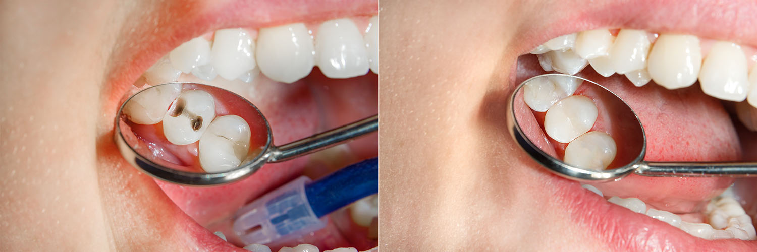 The image shows two photographs of a person s mouth with a toothbrush inside, highlighting dental hygiene practices.