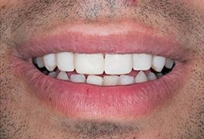 The image shows a close-up of a person s mouth with teeth, featuring a smile, and there appears to be a small amount of facial hair on the chin.