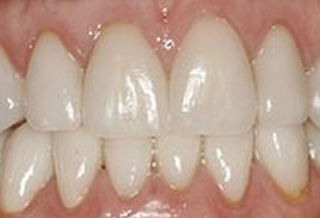 The image shows a close-up view of a person s teeth with a focus on the lower front teeth, which are visible in a smile.