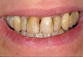 The image shows a person with yellowish teeth and gums, smiling broadly at the camera.