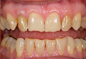 The image shows two close-up photographs of a person s teeth with yellowish stains and signs of decay, one on the left side of the mouth and the other on the right, both against a neutral background.
