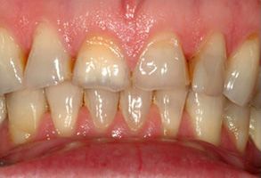The image displays two photographs of a person s mouth with teeth showing significant discoloration and decay, likely due to poor oral hygiene or dental issues.