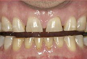 The image shows a person s teeth with yellow staining and a metal wire across them, suggesting a dental issue such as discoloration or the need for orthodontic treatment.
