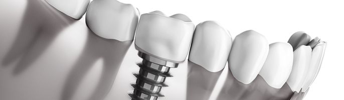 dental implants parker co