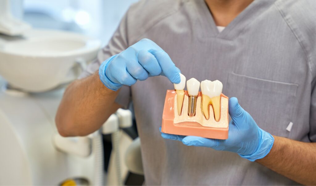 Types of Dental Implants Parker CO Dentist Plaza Dental Parker