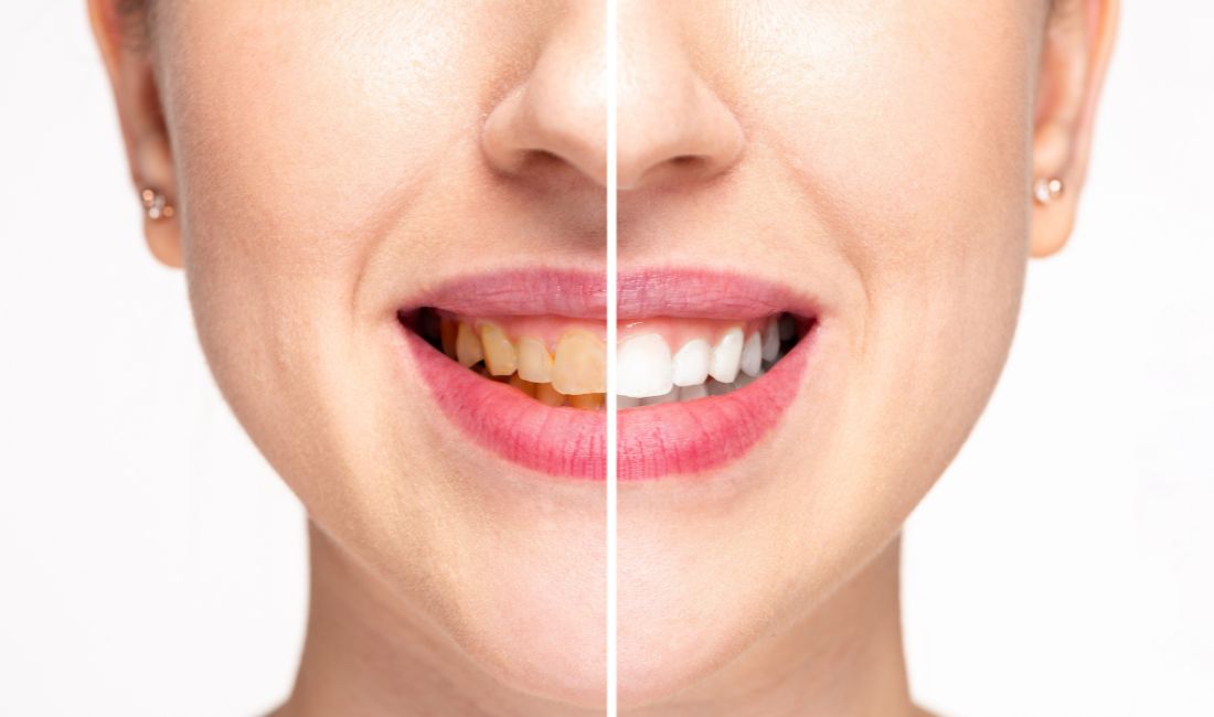 The Different Types of Teeth Whitening Treatments and Which One is Right for You (1)