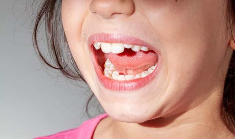 The Importance of Correcting Misaligned Teeth