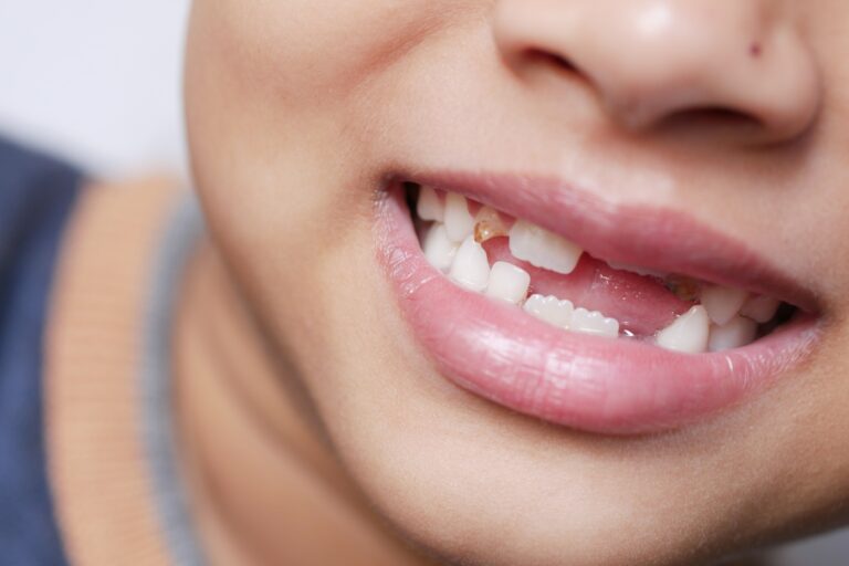 Close-up of a boy's mouth with chipped teeth, highlighting the importance of emergency dental care provided by Plaza Dental Parker in Parker, CO, to restore smiles and oral health